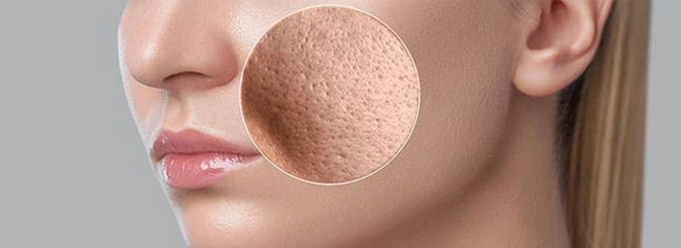 CİLTTEKİ GÖZENEKLER VE TEDAVİ YÖNTEMLERİ